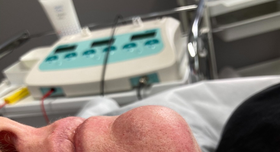 Electrolysis treatment at Smooth by Adina Skin